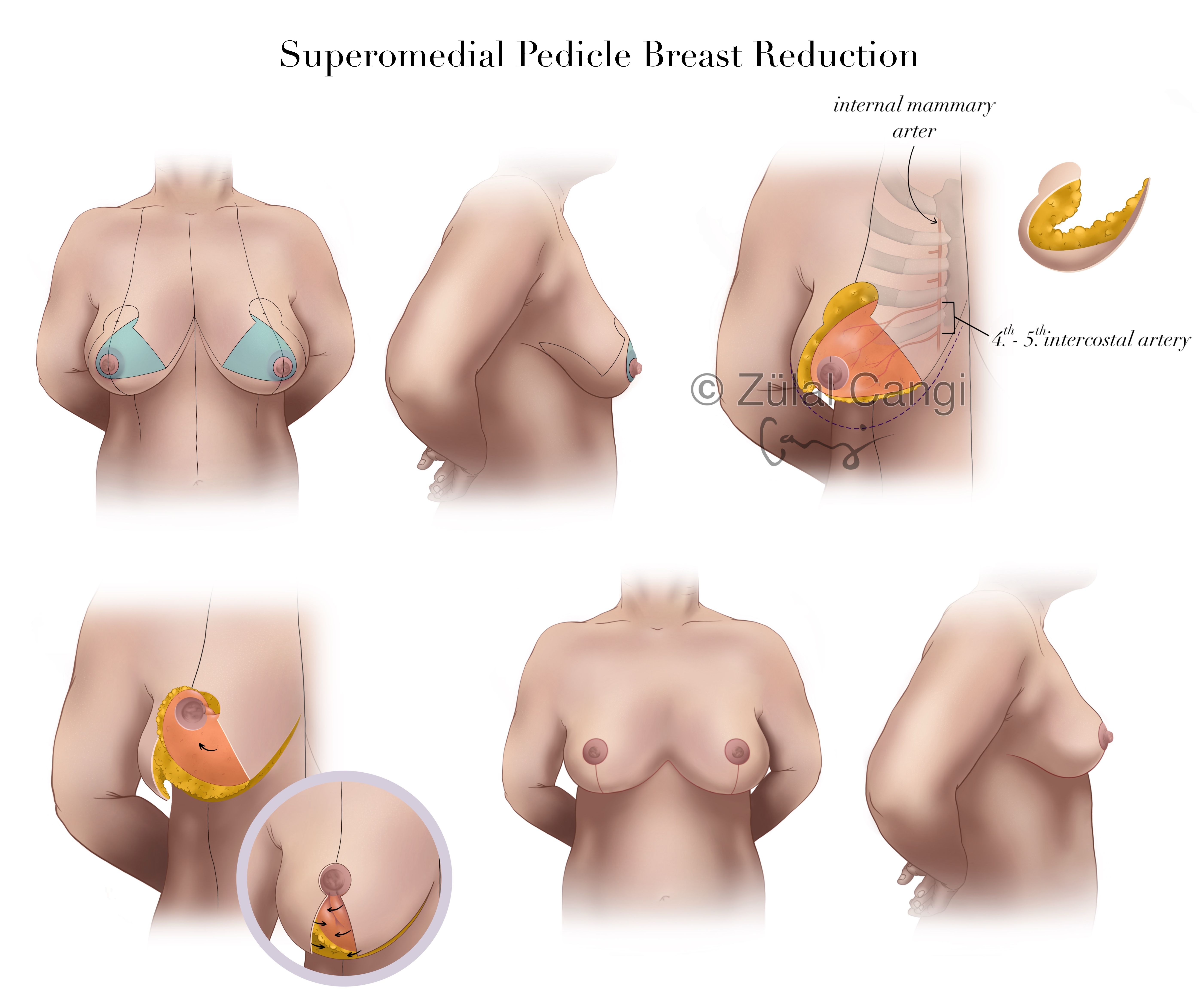 Superomedial Pedicle Breast Reduction