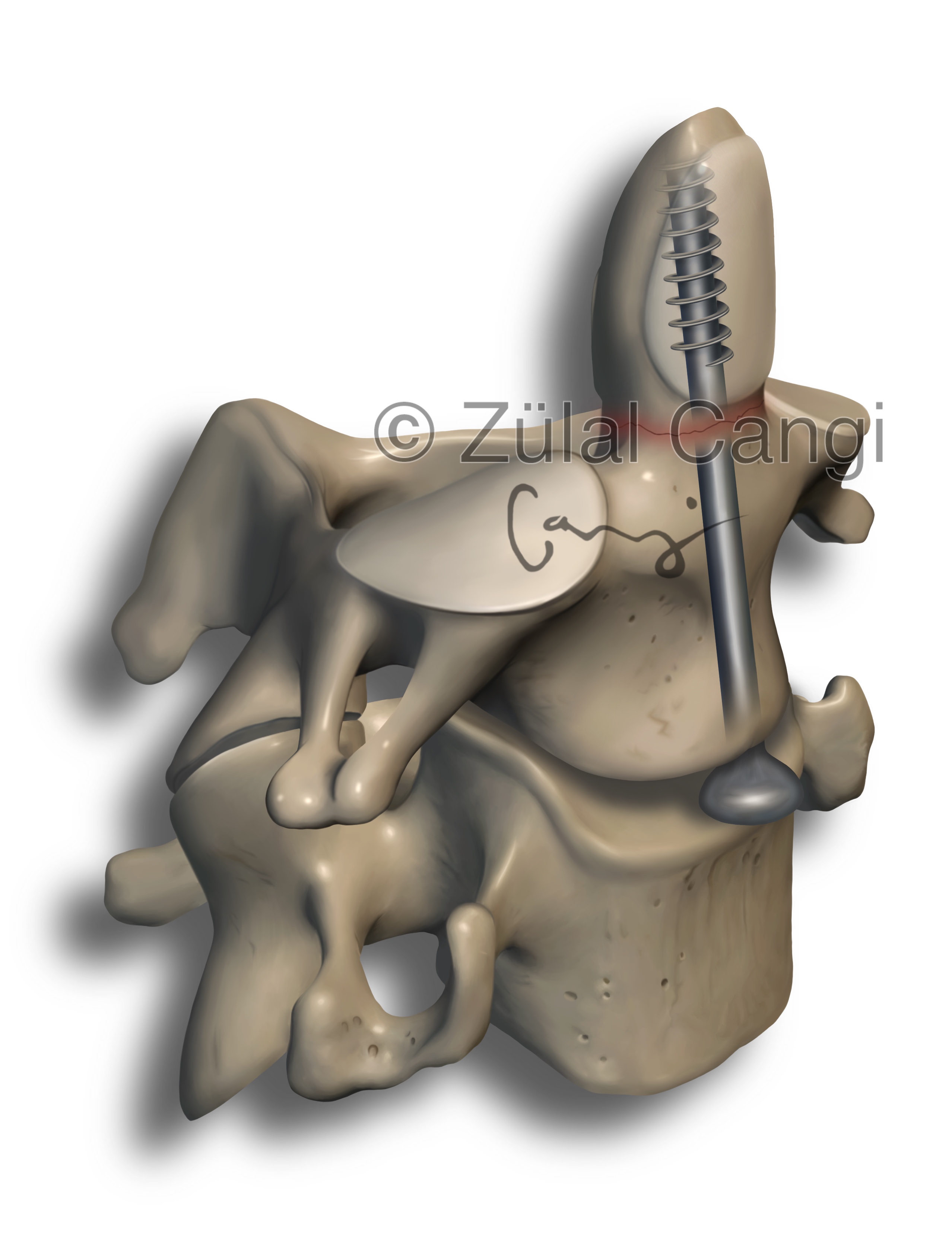Anterior Odontoid Screw Fixation